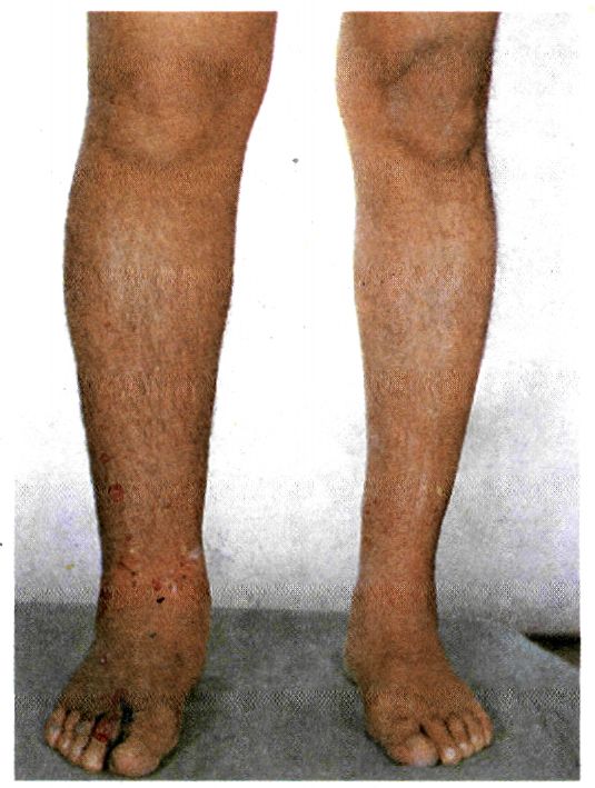 εικ. 4.5 Το δεξί πόδι του ατόμου αυτού εμφανίζει οίδημα