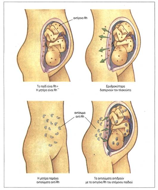 εικ. 3.22 Ανάπτυξη αιμολυτικής νόσου στο έμβρυο