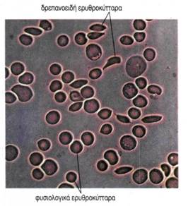 ει κ. 3.23 Ερυθροκύτταρο ατόμου με δρεπανοκυτταρική αναιμία