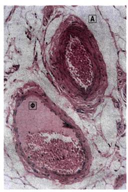 α) Τομή αρτηρίας (Α) και φλέβας (Φ)
