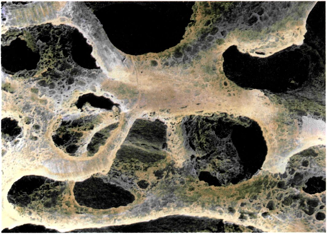 εικ. 7.7 Οστεοπόρωση