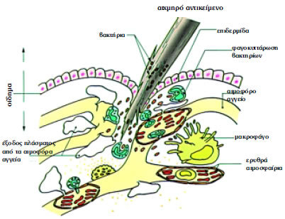 Εικόνα 1.20: Φλεγμονώδης αντίδραση μετά τον τραυματισμό του δέρματος από αιχμηρό αντικείμενο