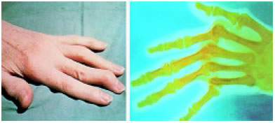 Εικόνα 1.29: Ρευματοειδής αρθρίτιδα