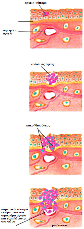 Εικόνα 1.39: Στάδια ανάπτυξης καρκίνου