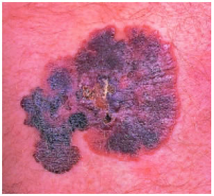 Εικόνα 2.37: Μελάνωμα, καρκίνος του δέρματος