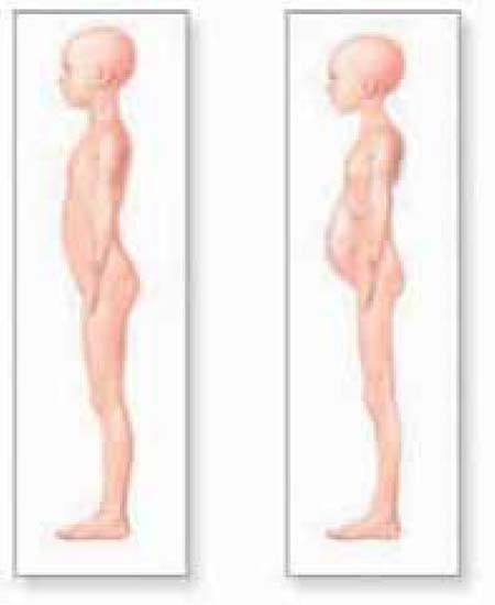 Εικ. 5.8 Η έλλειψη πρωτεΐνης και ενέργειας μπορεί να προκαλέσει είτε μαρασμό (σώμα πολύ αδύνατο χωρίς καθόλου λίπος) είτε Κβασιόρκορ (Kwashiorkor) (οίδημα/πρήξιμο στην κοιλιά)