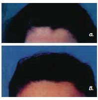 Εικ. 5.17 Γραμμή τριχοφυίας: με κορυφή (α), χωρίς κορυφή (Β).