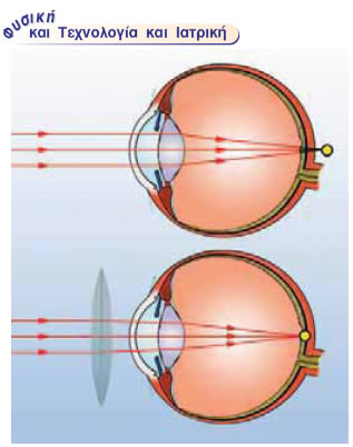 Η πρεσβυωπία και η διόρθωσή της