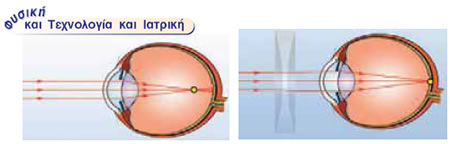 Η μυωπία και η διόρθωσή της